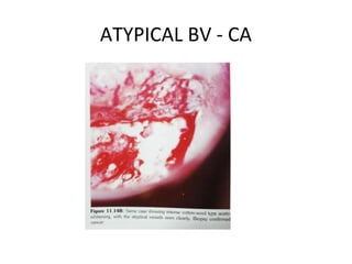 ATYPICAL BV - CA

 