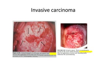 Invasive carcinoma

 