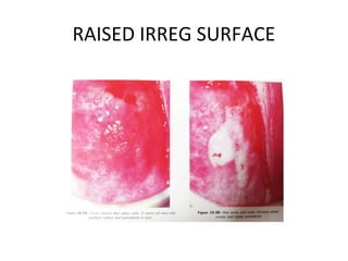 RAISED IRREG SURFACE

 