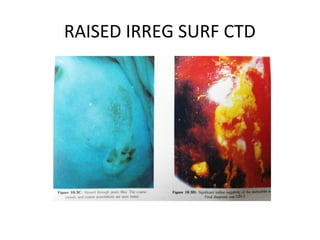 RAISED IRREG SURF CTD

 