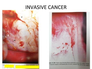 INVASIVE CANCER

 
