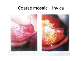 Coarse mosaic – inv ca

 