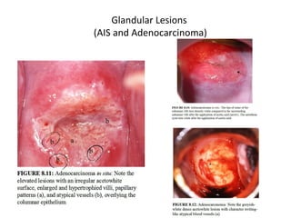 Glandular Lesions
(AIS and Adenocarcinoma)

 