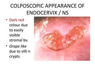 COLPOSCOPIC APPEARANCE OF
ENDOCERVIX / NS
• Dark red
colour due
to easily
visible
stromal bv.
• Grape like
due to villi n
crypts

 