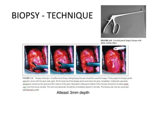 BIOPSY - TECHNIQUE

Atleast 3mm depth

 