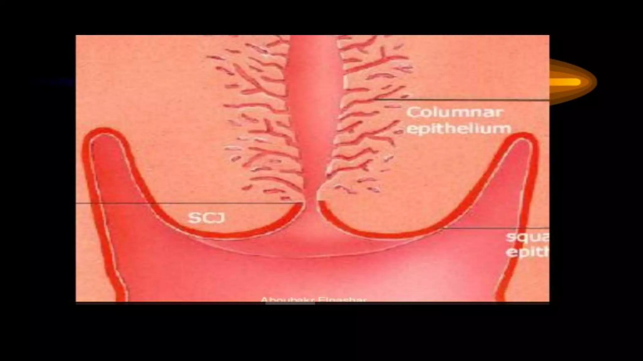 Colposcopy technique | PPTX