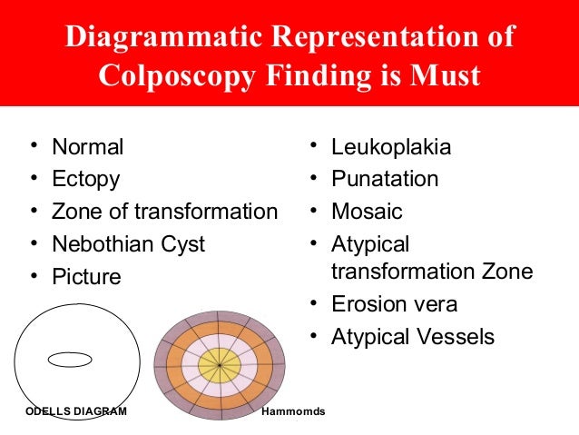 Mosaic Pattern Atypical Transformation Zone | colposcopy today practical approach dr sharda jain Mosaic Pattern Atypical Transformation Zone | colposcopy today practical approach dr sharda jain