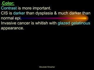 .Color:
Contrast is more important.
CIS is darker than dysplasia & much darker than
normal epi.
Invasive cancer is whitish with glazed gelatinous
appearance.
Aboubakr Elnashar
 