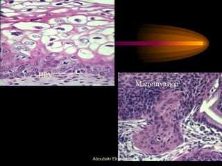HPV
Microinvasion
Aboubakr Elnashar
 
