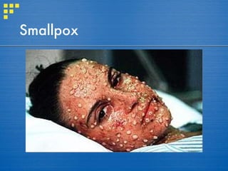 Smallpox 