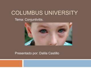 COLUMBUS UNIVERSITY
Tema: Conjuntivitis.
Presentado por: Dalila Castillo
 