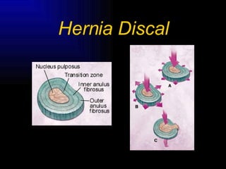 Hernia Discal 