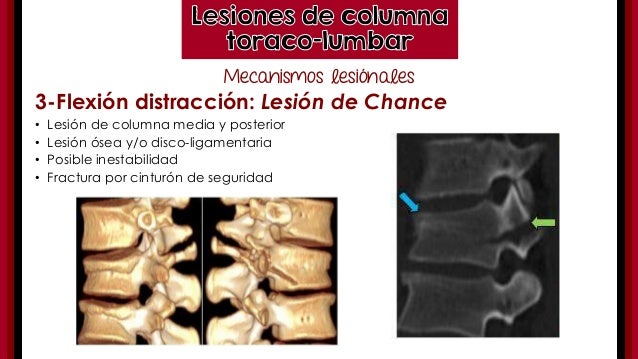 Traumatismo de columna toracolumbar