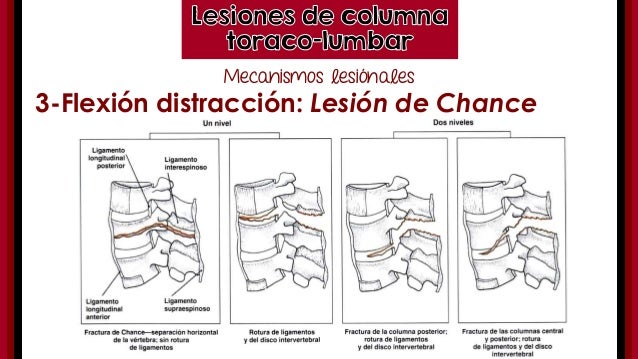 Traumatismo de columna toracolumbar