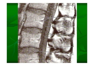 Columna Vertebral