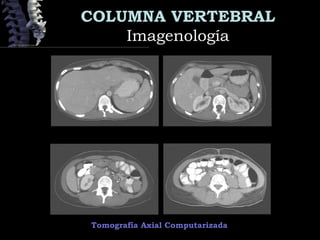 COLUMNA VERTEBRAL
ImagenologíaImagenología
Tomografía Axial Computarizada
 