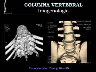 COLUMNA VERTEBRAL
ImagenologíaImagenología
Reconstrucción Tomográfica 3D
 