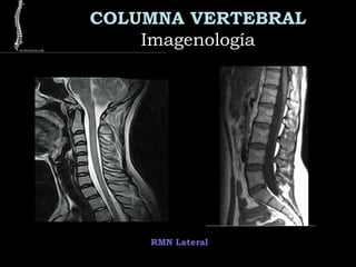 COLUMNA VERTEBRAL
ImagenologíaImagenología
RMN Lateral
 