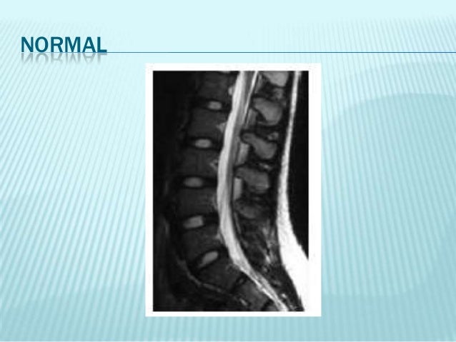Las hernias protruzii a sheynom la osteocondrosis el tratamiento