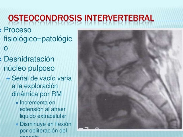 La osteocondrosis l5-s1 del departamento de la columna vertebral con la hernia del disco