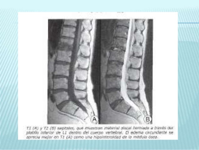 La osteocondrosis del departamento lumbar no pasa el dolor