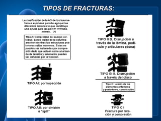 TIPOS DE FRACTURAS:
 