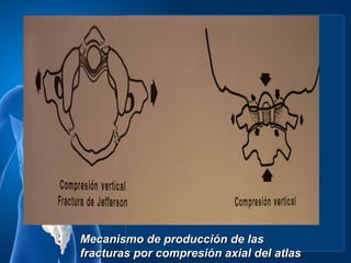Mecanismo de producción de las
fracturas por compresión axial del atlas
 