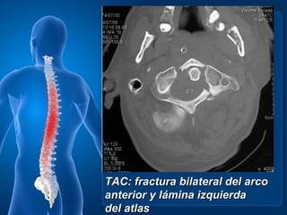 TAC: fractura bilateral del arco
anterior y lámina izquierda
del atlas
 