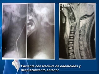 Paciente con fractura de odontoides y
desplazamiento anterior
 