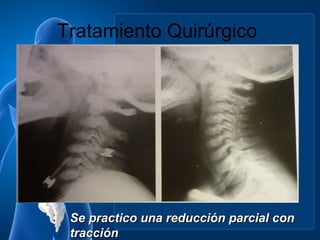 Tratamiento Quirúrgico




 Se practico una reducción parcial con
 tracción
 