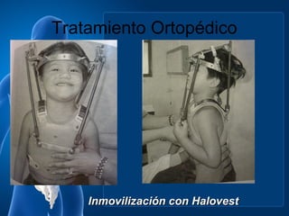 Tratamiento Ortopédico




    Inmovilización con Halovest
 