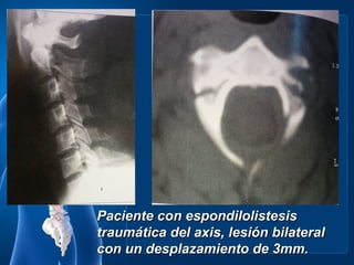 Paciente con espondilolistesis
traumática del axis, lesión bilateral
con un desplazamiento de 3mm.
 