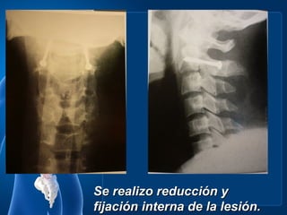 Se realizo reducción y
fijación interna de la lesión.
 