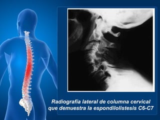 Radiografía lateral de columna cervical
que demuestra la espondilolistesis C6-C7
 