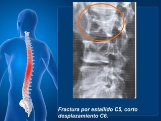 Fractura por estallido C5, corto
desplazamiento C6.
 