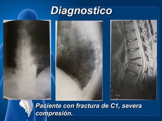 Diagnostico




Paciente con fractura de C1, severa
compresión.
 