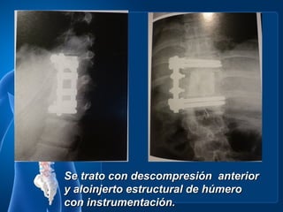 Se trato con descompresión anterior
y aloinjerto estructural de húmero
con instrumentación.
 