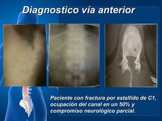 Diagnostico vía anterior




     Paciente con fractura por estallido de C1,
     ocupación del canal en un 50% y
     compromiso neurológico parcial.
 
