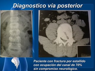 Diagnostico vía posterior




       Paciente con fractura por estallido
       con ocupación del canal de 70%
       sin compromiso neurológico.
 