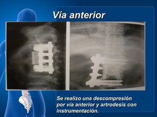 Vía anterior




 Se realizo una descompresión
 por vía anterior y artrodesis con
 instrumentación.
 