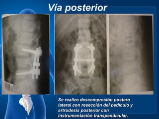 Vía posterior




  Se realizo descompresión postero
  lateral con resección del pedículo y
  artrodesis posterior con
  instrumentación transpendicular..
 
