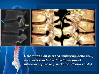 Deformidad en la placa superior(flecha azul)
asociada con la fractura lineal por el
proceso espinoso y pedículo (flecha verde)
 