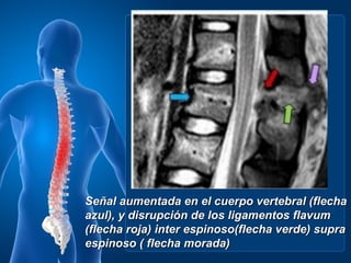 Señal aumentada en el cuerpo vertebral (flecha
azul), y disrupción de los ligamentos flavum
(flecha roja) inter espinoso(flecha verde) supra
espinoso ( flecha morada)
 
