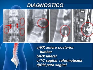 DIAGNOSTICO




  a) RX antero posterior
     lumbar
  b)RX lateral
  c) TC sagital reformateada
  d)RM para sagital
 