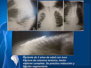 Paciente de 2 años de edad con luxo
fractura de columna torácica, lesión
medular completa. Se practico reducción y
fijación segmentaria.
 