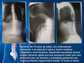 Paciente de 12 años de edad, con antecedente
automotor a la edad de 4 años y lesión medular
completa a nivel torácico. Desarrollo escoliosis toraco
lumbar derecha rígida que fue necesario tratar con una
liberación por vía anterior y artrodesis posterior con
instrumentación segmentaria desde T2 hasta el iliaco.
 