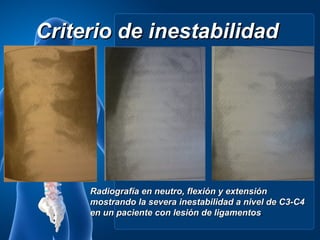 Criterio de inestabilidad




     Radiografía en neutro, flexión y extensión
     mostrando la severa inestabilidad a nivel de C3-C4
     en un paciente con lesión de ligamentos.
 