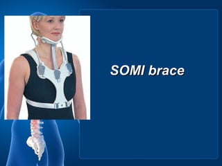 SOMI brace
 