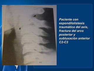 Paciente con
espondilolistesis
traumática del axis,
fractura del arco
posterior y
subluxación anterior
C2-C3
 