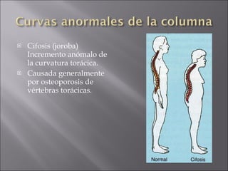 Cifosis (joroba) Incremento anómalo de la curvatura torácica. Causada generalmente por osteoporosis de vértebras torácicas. 